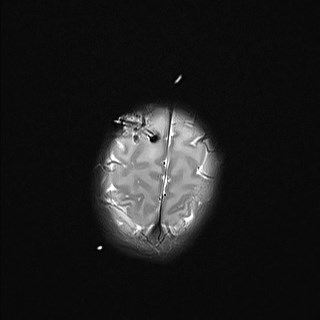 File:Atypical teratoid rhabdoid tumor (prenatal US and neonatal MRI) (Radiopaedia 59091-66388 Axial T2 27).jpg