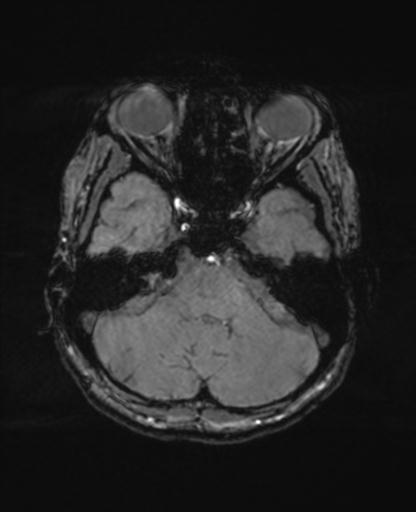 Autoimmune limbic encephalitis (Radiopaedia 30363-31005 SWI - magnitude 18).jpg