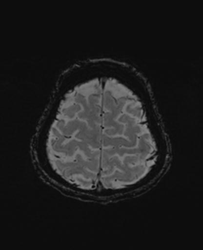 Autoimmune limbic encephalitis (Radiopaedia 30363-31005 SWI 69).jpg