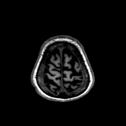 Autoimmune limbic encephalitis (Radiopaedia 30363-31005 T1 Axial 1mm 137).jpg