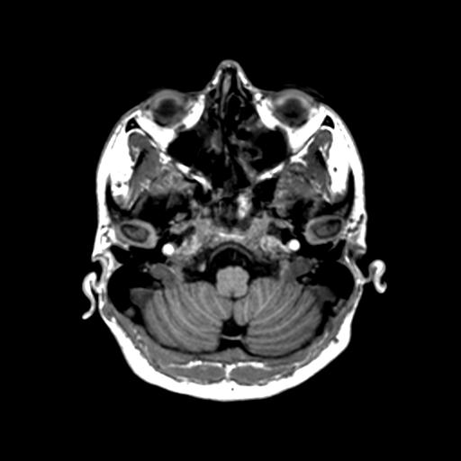 Autoimmune limbic encephalitis (Radiopaedia 30363-31005 T1 Axial 1mm 31).jpg