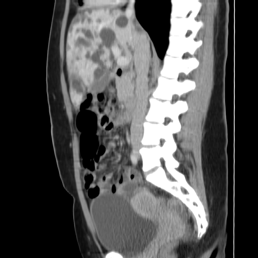 Autosomal dominant polycystic kidney disease (Radiopaedia 23061-23093 F 25).jpg