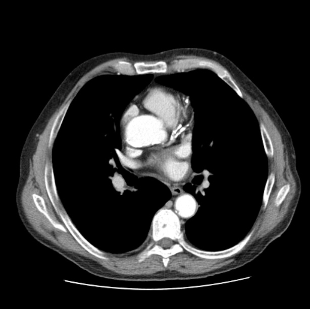Autosomal dominant polycystic kidney disease (Radiopaedia 27851-28094 B 31).jpg