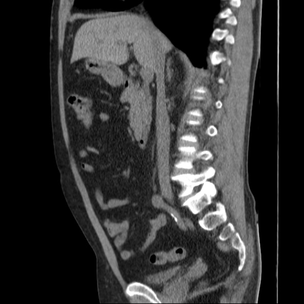 Autosomal dominant polycystic kidney disease (Radiopaedia 36539-38101 D 38).jpg
