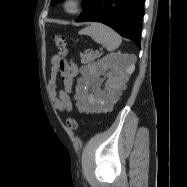 Autosomal dominant polycystic kidney disease (Radiopaedia 36539-38101 D 64).jpg