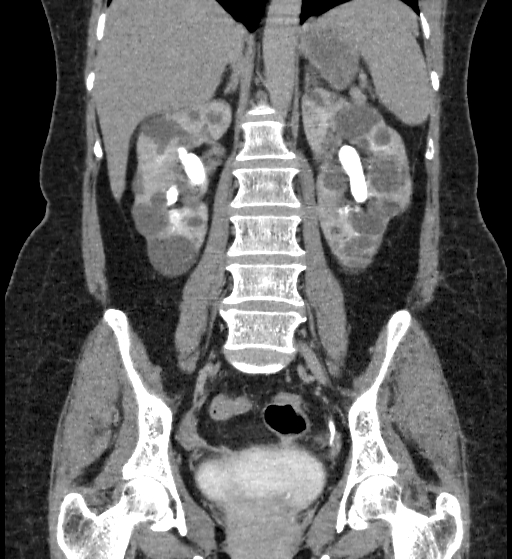File:Autosomal dominant polycystic kidney disease (Radiopaedia 38189-40194 Coronal C+ delayed 58).jpg