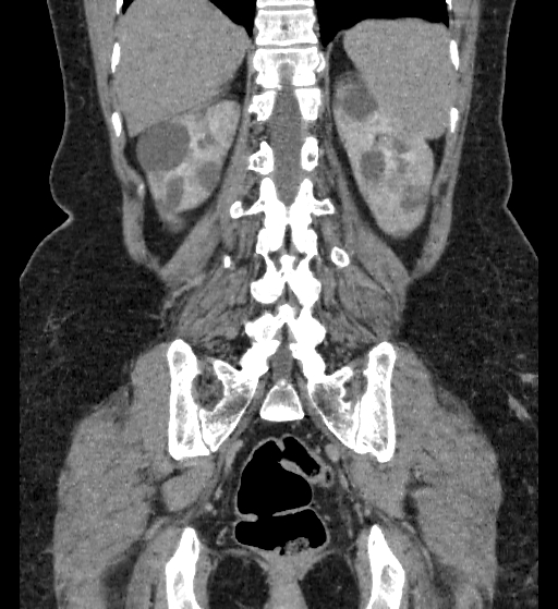 Autosomal dominant polycystic kidney disease (Radiopaedia 38189-40194 Coronal C+ delayed 81).jpg