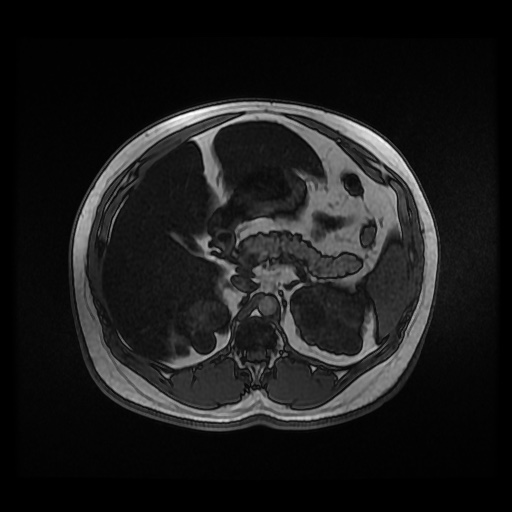 Autosomal dominant polycystic kidney disease (Radiopaedia 50259-55611 Axial 2D Dual Echo 35).jpg