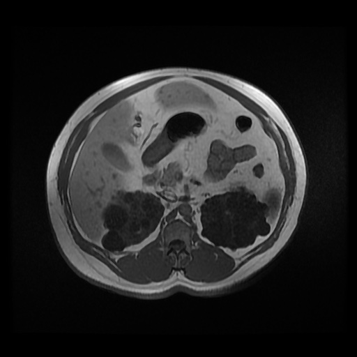 Autosomal dominant polycystic kidney disease (Radiopaedia 50259-55611 Axial 2D Dual Echo 40).jpg