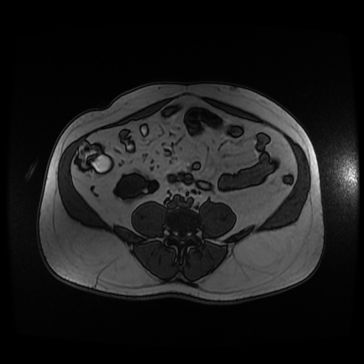 Autosomal dominant polycystic kidney disease (Radiopaedia 50259-55611 Axial 2D Dual Echo 69).jpg