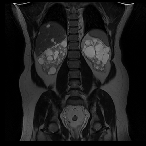 File:Autosomal dominant polycystic kidney disease (Radiopaedia 50259-55611 Coronal T2 26).jpg