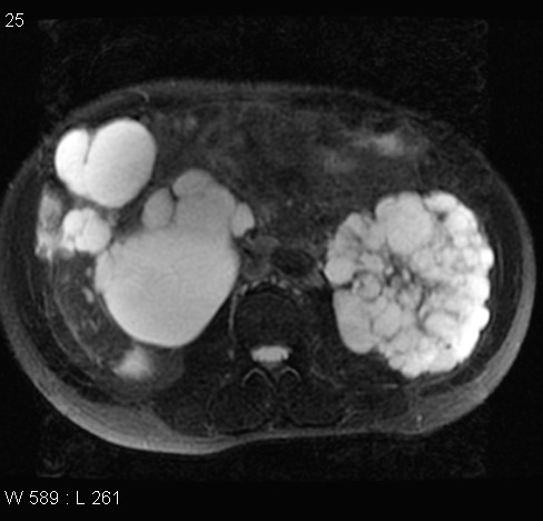 File:Autosomal dominant polycystic kidney disease (Radiopaedia 5202-6969 Axial T2 fat sat 10).jpg