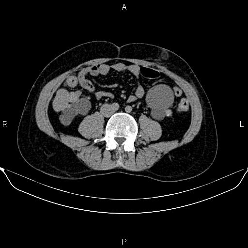 Autosomal dominant polycystic kidney disease (Radiopaedia 87830-104287 Axial non-contrast 34).jpg