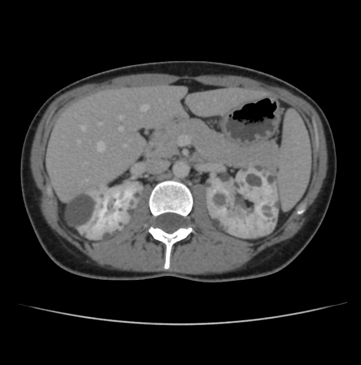 Autosomal dominant polycystic kidney disease - early onset (Radiopaedia 40734-43387 A 23).jpg