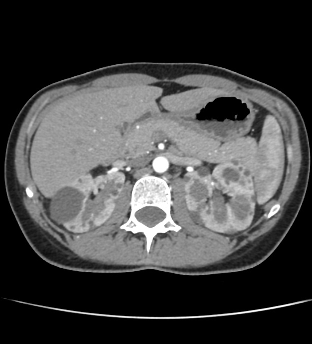 Autosomal dominant polycystic kidney disease - early onset (Radiopaedia 40734-43387 B 16).jpg