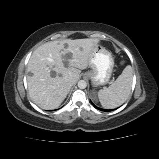 File:Autosomal dominant polycystic kidney disease with hepatic involvement (Radiopaedia 32693-33662 B 14).jpg