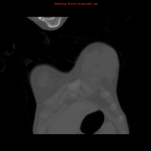 Avascular necrosis in sickle cell disease (Radiopaedia 17448-17152 Coronal bone window 8).jpg