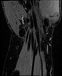 Avascular necrosis of the capitate (Radiopaedia 88317-104948 Coronal T1 vibe 70).jpg