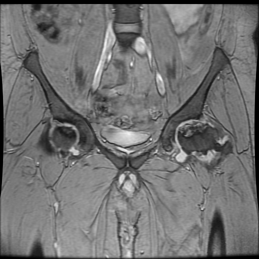 Avascular necrosis of the hip (Radiopaedia 61503-69465 F 32).jpg