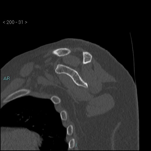 Avascular necrosis of the shoulder - Cruess stage I (Radiopaedia 77674-89887 Sagittal bone window 30).jpg