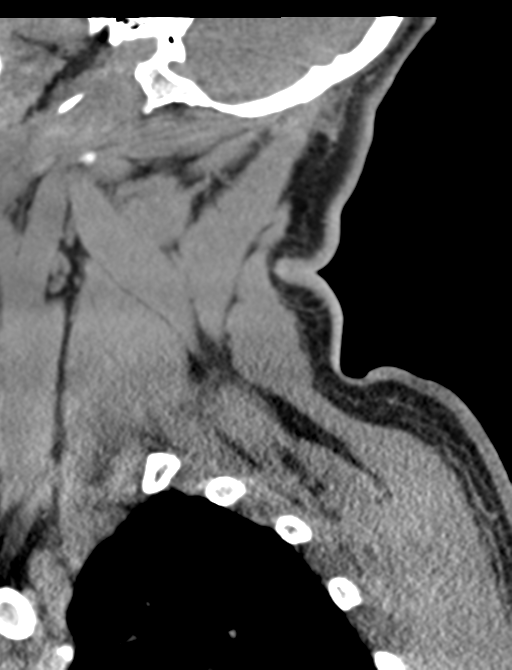 Axis peg fracture (type 3) and atlas lateral mass (type 4) fracture (Radiopaedia 37474-39324 D 9).png