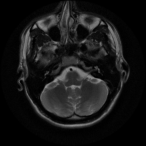 File:Azygos anterior cerebral artery (Radiopaedia 17059-16756 Axial T2 20).jpg