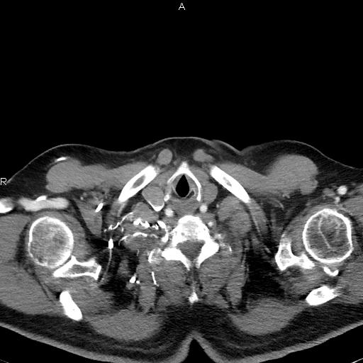 File:Azygos continuation of the inferior vena cava (Radiopaedia 18537-18404 C+ arterial phase 3).jpg