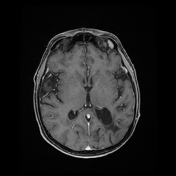 Balo concentric sclerosis (Radiopaedia 53875-59982 Axial LAVA C+ 139).jpg