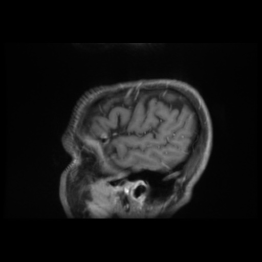 Balo concentric sclerosis (Radiopaedia 53875-59982 Sagittal LAVA C+ 15).jpg