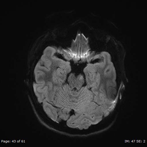 File:Balo concentric sclerosis (Radiopaedia 61637-69636 Axial DWI 43).jpg