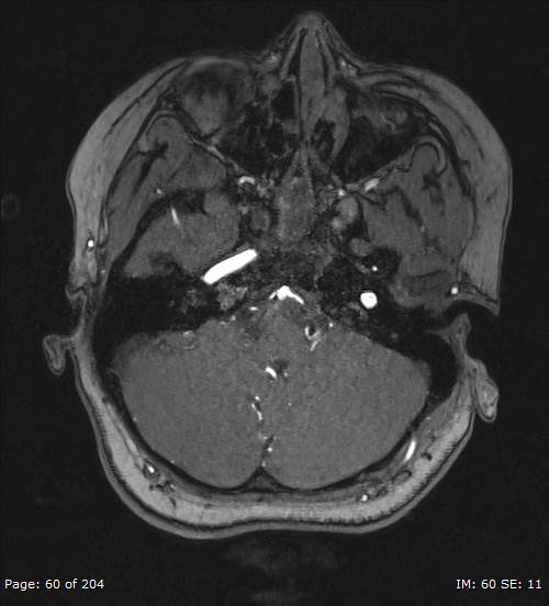 Balo concentric sclerosis (Radiopaedia 61637-69636 Axial MRA 60).jpg