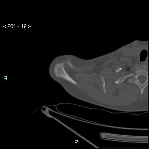 Bankart lesion with glenoid bone defect - assessment TC with PICO method (Radiopaedia 42855-93901 Axial bone window 17).jpg