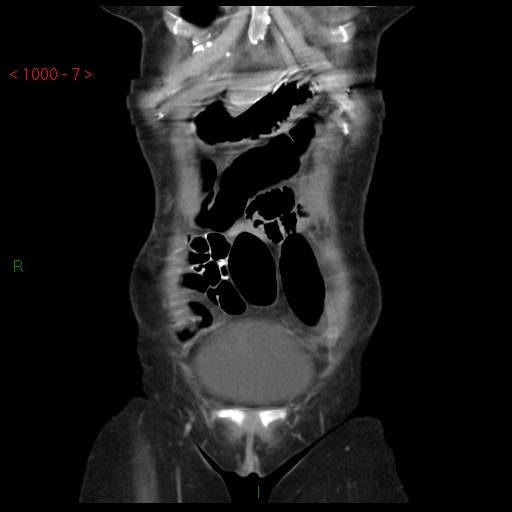 File:Bartholin gland cyst (Radiopaedia 54904-61181 Coronal C+ delayed 7).jpg