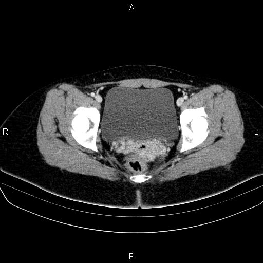 File:Bartholin gland cyst (Radiopaedia 62635-70930 Axial Post contrast 61).jpg