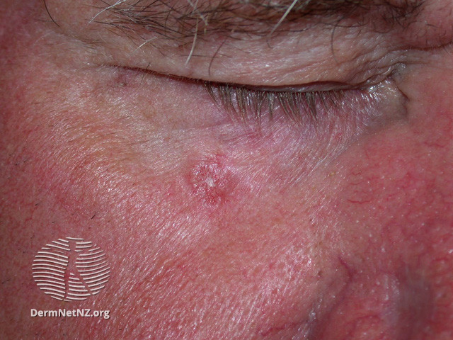 Basal cell carcinoma affecting the face (DermNet NZ lesions-bcc-face-1208).jpg
