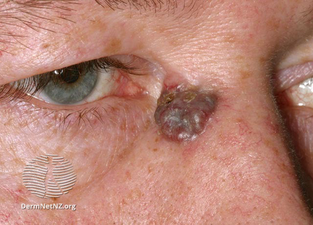 File:Basal cell carcinoma affecting the nose (DermNet NZ lesions-bcc-nose-0660).jpg