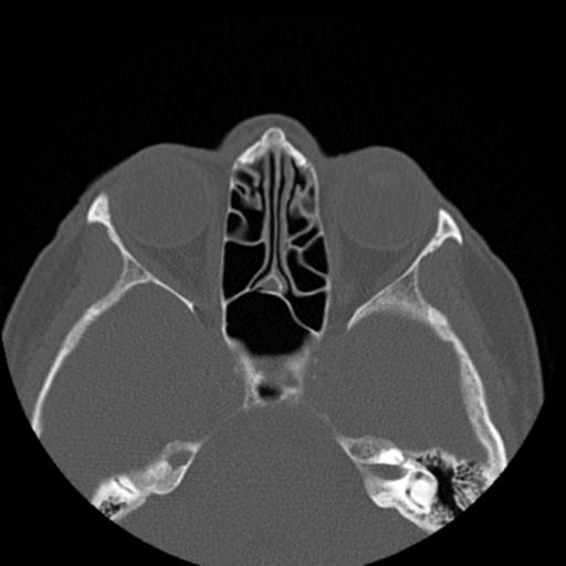 File:Base of skull chondrosarcoma (Radiopaedia 30410-31071 Axial bone window 26).jpg