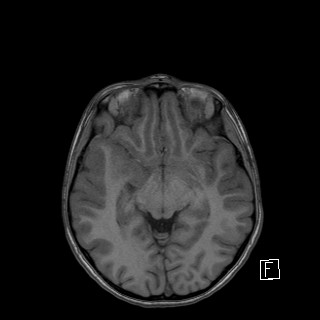 File:Base of skull rhabdomyosarcoma (Radiopaedia 32196-33142 Axial T1 23).jpg