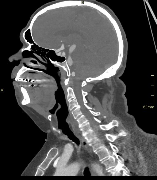 Basilar artery aneurysm (Radiopaedia 56261-62932 C 34).jpg