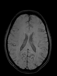 Basilar artery perforator aneurysm (Radiopaedia 82455-97733 Axial SWI 36).jpg