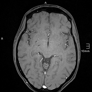 Basilar artery perforator aneurysm (Radiopaedia 82455-99523 F 69).jpg