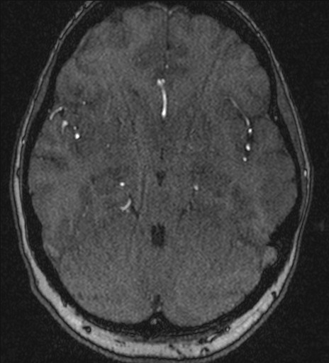 Basilar tip aneurysm (Radiopaedia 26504-26632 MRA 90).jpg
