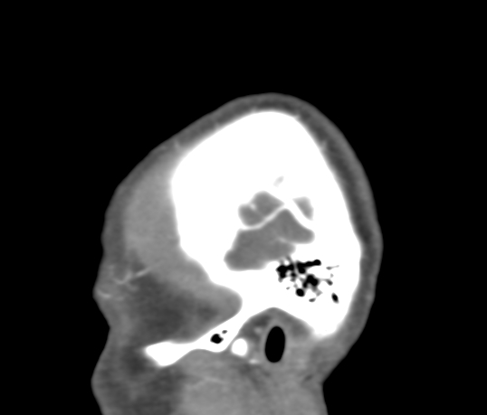 Basilar tip aneurysm with coiling (Radiopaedia 53912-60086 C 3).jpg