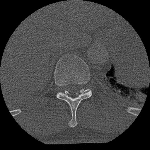Benign post-traumatic pseudopneumoperitoneum (Radiopaedia 71199-81495 Axial bone window 151).jpg