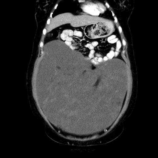 File:Benign spindle cell tumor - abdominopelvic (Radiopaedia 61300-69212 C 17).jpg