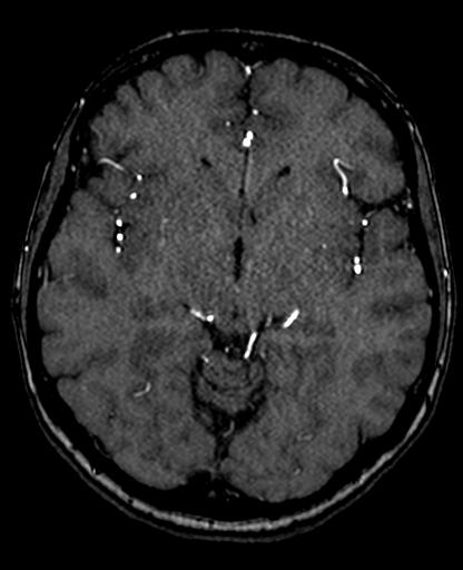 Berry aneurysm of the terminal internal carotid artery (Radiopaedia 88286-104918 Axial TOF 118).jpg