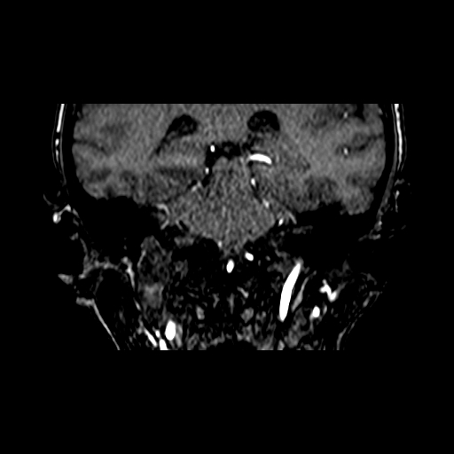 Berry aneurysm of the terminal internal carotid artery (Radiopaedia 88286-104918 Coronal TOF 67).jpg