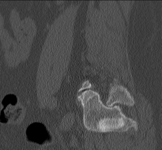 Bertolotti syndrome (Radiopaedia 24864-25128 Sagittal bone window 49).jpg