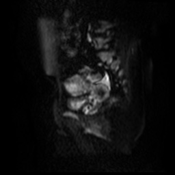 File:Bicornuate uterus (Radiopaedia 51676-57472 Sagittal DWI 17).jpg
