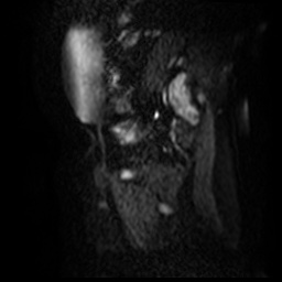 File:Bicornuate uterus (Radiopaedia 51676-57472 Sagittal DWI 7).jpg